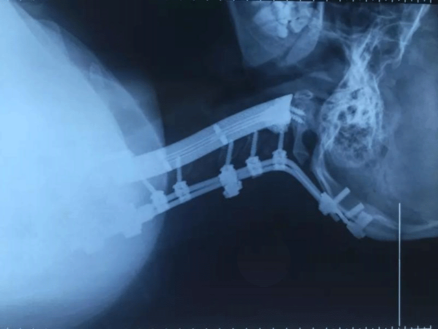 Spine-implant-edit