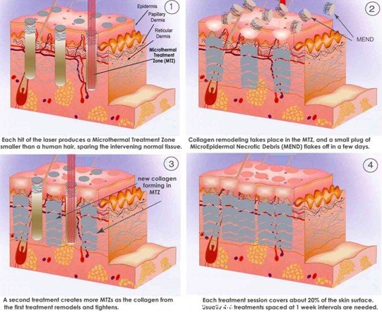 像素激光,飞梭镭射)技术是一种新型的治疗方法