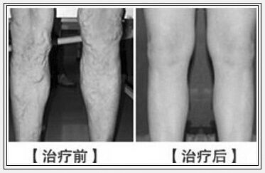 超微创激光术 让顶梁柱摆脱静脉曲张折磨-医