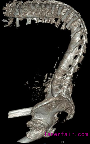 X射线下显示吴先生脊柱已严重弯曲